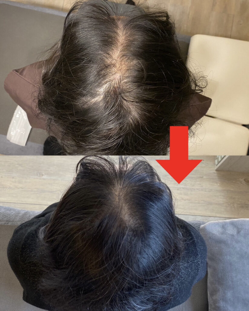 えーる育毛鍼ビフォーアフター②